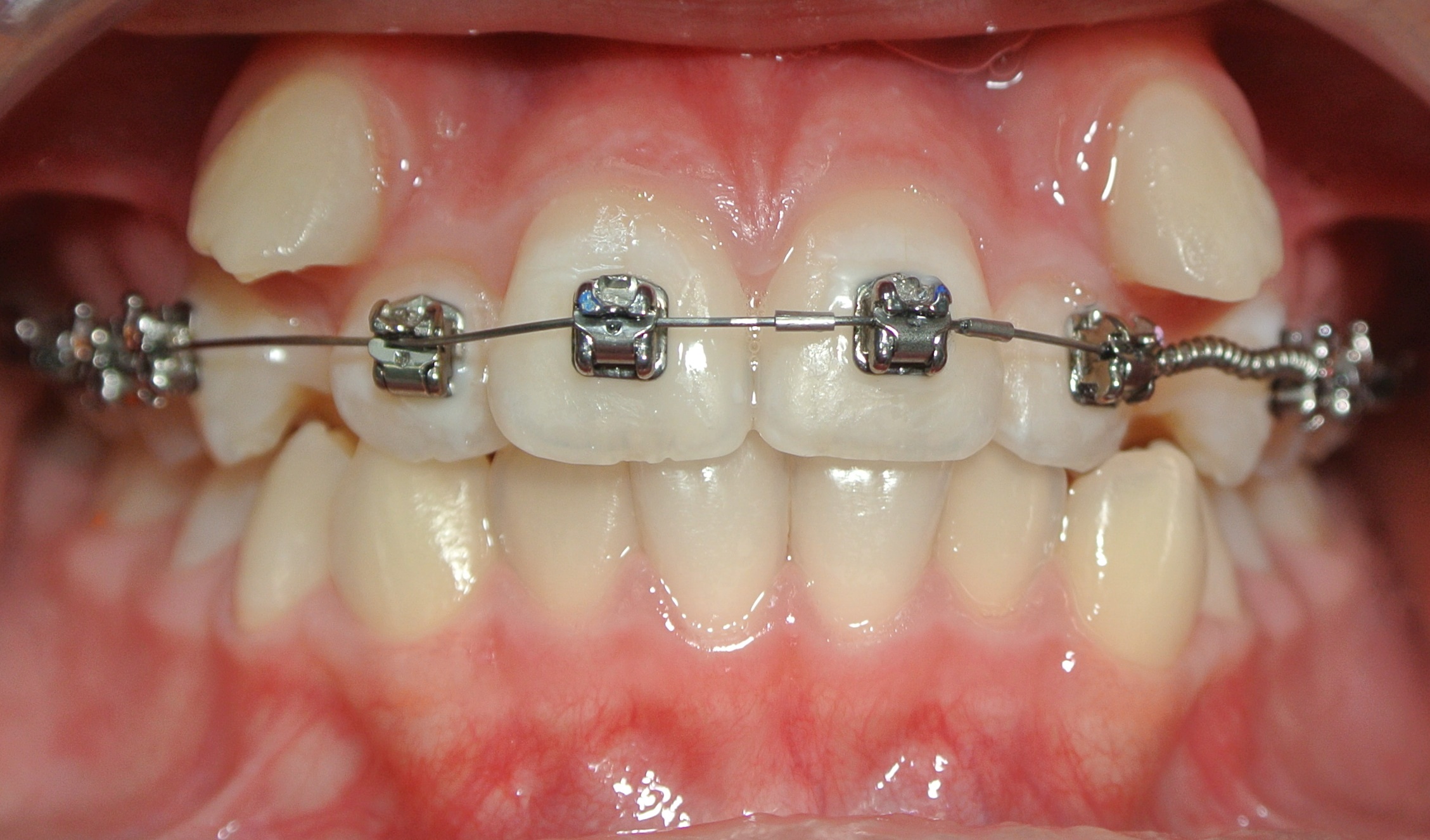Clinebell orthodontics